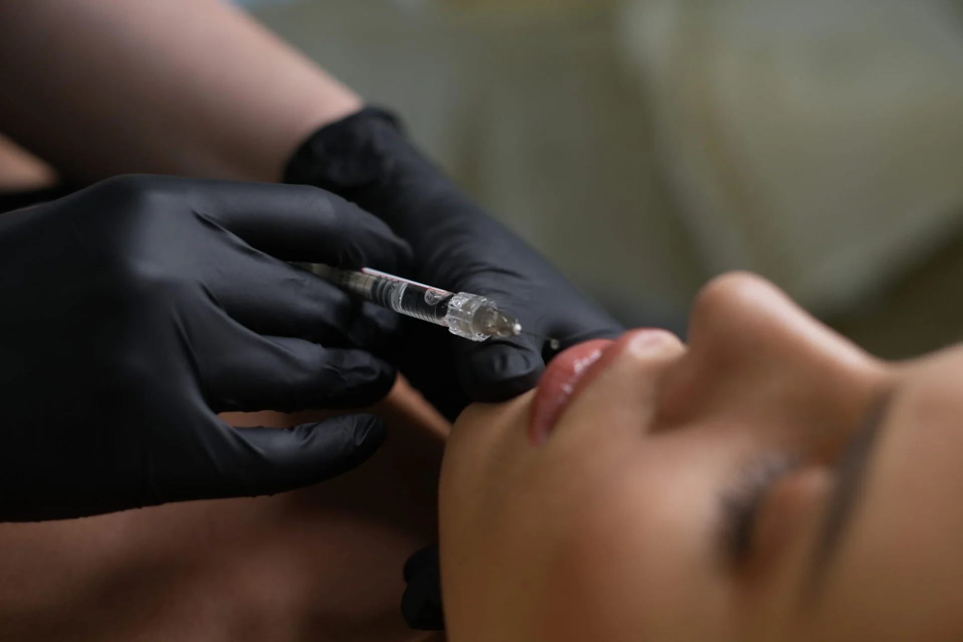 Hijaluronski fileri fotografija 4 - a.mi medspa
